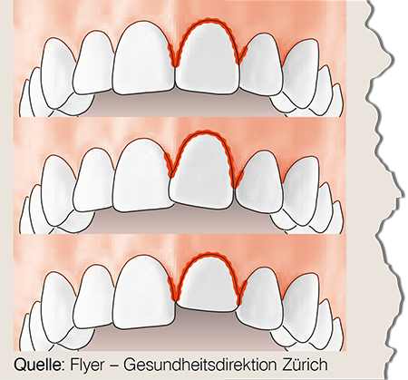 Quelle: Flyer – Gesundheitsdirektion Zürich